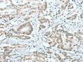 The image on the left is immunohistochemistry of paraffin-embedded Human colon cancer tissue using CSB-PA233816(ASH2L Antibody) at dilution 1/60, on the right is treated with fusion protein. (Original magnification: ×200)