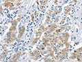 The image on the left is immunohistochemistry of paraffin-embedded Human liver cancer tissue using CSB-PA234397(LRP6 Antibody) at dilution 1/60, on the right is treated with synthetic peptide. (Original magnification: ×200)