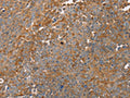 The image on the left is immunohistochemistry of paraffin-embedded Human ovarian cancer tissue using CSB-PA234848(FAIM2 Antibody) at dilution 1/30, on the right is treated with fusion protein. (Original magnification: ×200)