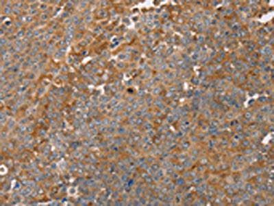 The image on the left is immunohistochemistry of paraffin-embedded Human ovarian cancer tissue using CSB-PA234848(FAIM2 Antibody) at dilution 1/30, on the right is treated with fusion protein. (Original magnification: ×200)