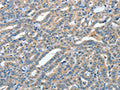 The image on the left is immunohistochemistry of paraffin-embedded Human thyroid cancer tissue using CSB-PA235182(ANGPT1 Antibody) at dilution 1/50, on the right is treated with fusion protein. (Original magnification: ×200)