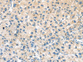 The image on the left is immunohistochemistry of paraffin-embedded Human liver cancer tissue using CSB-PA235900(ADRB3 Antibody) at dilution 1/20, on the right is treated with synthetic peptide. (Original magnification: ×200)