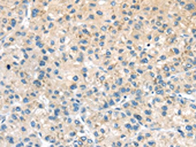 The image on the left is immunohistochemistry of paraffin-embedded Human liver cancer tissue using CSB-PA235900(ADRB3 Antibody) at dilution 1/20, on the right is treated with synthetic peptide. (Original magnification: ×200)