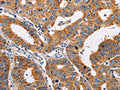 The image on the left is immunohistochemistry of paraffin-embedded Human gastic cancer tissue using CSB-PA235954(ADH1A Antibody) at dilution 1/25, on the right is treated with fusion protein. (Original magnification: ×200)