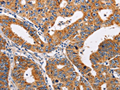The image on the left is immunohistochemistry of paraffin-embedded Human gastic cancer tissue using CSB-PA235954(ADH1A Antibody) at dilution 1/25, on the right is treated with fusion protein. (Original magnification: ×200)