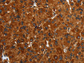 The image on the left is immunohistochemistry of paraffin-embedded Human liver cancer tissue using CSB-PA235961(ENTPD7 Antibody) at dilution 1/40, on the right is treated with fusion protein. (Original magnification: ×200)