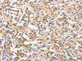 The image on the left is immunohistochemistry of paraffin-embedded Human thyroid cancer tissue using CSB-PA236190(ANKMY2 Antibody) at dilution 1/25, on the right is treated with fusion protein. (Original magnification: ×200)