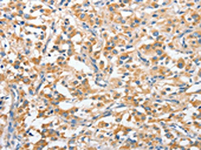The image on the left is immunohistochemistry of paraffin-embedded Human thyroid cancer tissue using CSB-PA236190(ANKMY2 Antibody) at dilution 1/25, on the right is treated with fusion protein. (Original magnification: ×200)