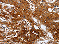 The image on the left is immunohistochemistry of paraffin-embedded Human lung cancer tissue using CSB-PA236241(PLAUR Antibody) at dilution 1/60, on the right is treated with fusion protein. (Original magnification: ×200)