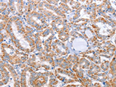 The image on the left is immunohistochemistry of paraffin-embedded Human thyroid cancer tissue using CSB-PA236618(KIF3A Antibody) at dilution 1/25, on the right is treated with fusion protein. (Original magnification: ×200)