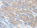 The image on the left is immunohistochemistry of paraffin-embedded Human esophagus cancer tissue using CSB-PA236720(ADAM2 Antibody) at dilution 1/20, on the right is treated with fusion protein. (Original magnification: ×200)