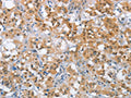 The image on the left is immunohistochemistry of paraffin-embedded Human thyroid cancer tissue using CSB-PA236767(MLH1 Antibody) at dilution 1/65, on the right is treated with fusion protein. (Original magnification: ×200)
