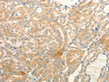 The image on the left is immunohistochemistry of paraffin-embedded Human thyroid cancer tissue using CSB-PA236814(TPH1 Antibody) at dilution 1/25, on the right is treated with fusion protein. (Original magnification: ×200)