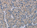 The image on the left is immunohistochemistry of paraffin-embedded Human liver cancer tissue using CSB-PA236888(KLHL2 Antibody) at dilution 1/20, on the right is treated with fusion protein. (Original magnification: ×200)