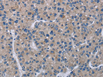 The image on the left is immunohistochemistry of paraffin-embedded Human liver cancer tissue using CSB-PA236888(KLHL2 Antibody) at dilution 1/20, on the right is treated with fusion protein. (Original magnification: ×200)