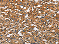 The image on the left is immunohistochemistry of paraffin-embedded Human thyroid cancer tissue using CSB-PA237032(BLK Antibody) at dilution 1/20, on the right is treated with fusion protein. (Original magnification: ×200)