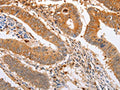 The image on the left is immunohistochemistry of paraffin-embedded Human colon cancer tissue using CSB-PA237602(SERP1 Antibody) at dilution 1/20, on the right is treated with fusion protein. (Original magnification: ×200)