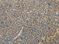 The image on the left is immunohistochemistry of paraffin-embedded Human liver cancer tissue using CSB-PA237733(TLR4 Antibody) at dilution 1/30, on the right is treated with fusion protein. (Original magnification: ×200)