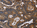 The image on the left is immunohistochemistry of paraffin-embedded Human colon cancer tissue using CSB-PA237744(FGB Antibody) at dilution 1/20, on the right is treated with fusion protein. (Original magnification: ×200)