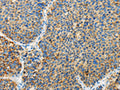 The image on the left is immunohistochemistry of paraffin-embedded Human liver cancer tissue using CSB-PA238135(ARHGEF3 Antibody) at dilution 1/25, on the right is treated with fusion protein. (Original magnification: ×200)
