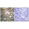 Immunohistochemistry analysis of paraffin-embedded human breast carcinoma tissue using XPA antibody.