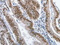 The image on the left is immunohistochemistry of paraffin-embedded Human colon cancer tissue using CSB-PA238659(GNRH1 Antibody) at dilution 1/70, on the right is treated with fusion protein. (Original magnification: ×200)