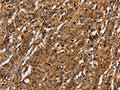 The image on the left is immunohistochemistry of paraffin-embedded Human gastic cancer tissue using CSB-PA238929(ICAM1 Antibody) at dilution 1/40, on the right is treated with fusion protein. (Original magnification: ×200)