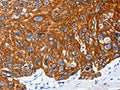The image on the left is immunohistochemistry of paraffin-embedded Human esophagus cancer tissue using CSB-PA239200(NFATC1 Antibody) at dilution 1/25, on the right is treated with fusion protein. (Original magnification: ×200)