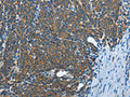 The image on the left is immunohistochemistry of paraffin-embedded Human lymphoma tissue using CSB-PA239289(IL13RA2 Antibody) at dilution 1/30, on the right is treated with fusion protein. (Original magnification: ×200)