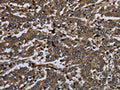 The image on the left is immunohistochemistry of paraffin-embedded Human liver cancer tissue using CSB-PA239383(GP1BA Antibody) at dilution 1/60, on the right is treated with fusion protein. (Original magnification: ×200)