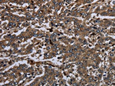 The image on the left is immunohistochemistry of paraffin-embedded Human liver cancer tissue using CSB-PA239383(GP1BA Antibody) at dilution 1/60, on the right is treated with fusion protein. (Original magnification: ×200)