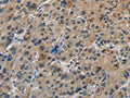 The image on the left is immunohistochemistry of paraffin-embedded Human liver cancer tissue using CSB-PA239746(IL31 Antibody) at dilution 1/20, on the right is treated with synthetic peptide. (Original magnification: ×200)