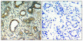 Immunohistochemical analysis of paraffin-embedded human breast carcinoma tissue using SHP-2(Phospho-Tyr580) Antibody(left) or the same antibody preincubated with blocking peptide(right).