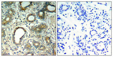 Immunohistochemical analysis of paraffin-embedded human breast carcinoma tissue using SHP-2(Phospho-Tyr580) Antibody(left) or the same antibody preincubated with blocking peptide(right).