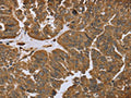 The image on the left is immunohistochemistry of paraffin-embedded Human ovarian cancer tissue using CSB-PA240464(IKBIP Antibody) at dilution 1/40, on the right is treated with fusion protein. (Original magnification: ×200)