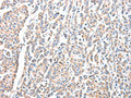 The image on the left is immunohistochemistry of paraffin-embedded Human breast cancer tissue using CSB-PA240615(ADA Antibody) at dilution 1/15, on the right is treated with fusion protein. (Original magnification: ×200)