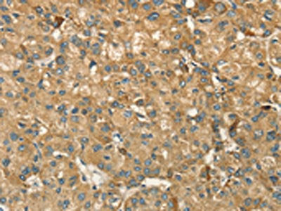 The image on the left is immunohistochemistry of paraffin-embedded Human liver cancer tissue using CSB-PA240849(HSD17B8 Antibody) at dilution 1/55, on the right is treated with fusion protein. (Original magnification: ×200)