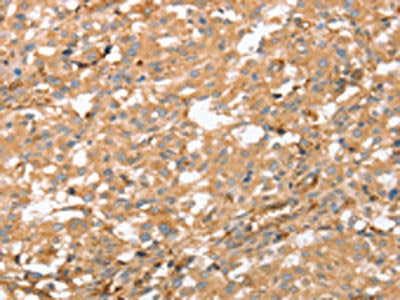 The image on the left is immunohistochemistry of paraffin-embedded Human thyroid cancer tissue using CSB-PA241286(AHSG Antibody) at dilution 1/60, on the right is treated with fusion protein. (Original magnification: ×200)