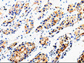 The image is immunohistochemistry of paraffin-embedded Human liver cancer tissue using CSB-PA241484(COX16 Antibody) at dilution 1/50. (Original magnification: ×200)