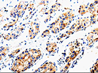 The image is immunohistochemistry of paraffin-embedded Human liver cancer tissue using CSB-PA241484(COX16 Antibody) at dilution 1/50. (Original magnification: ×200)