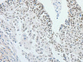 The image on the left is immunohistochemistry of paraffin-embedded Human cervical cancer tissue using CSB-PA241902(RPS6KB1 Antibody) at dilution 1/25, on the right is treated with fusion protein. (Original magnification: ×200)