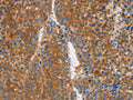 The image on the left is immunohistochemistry of paraffin-embedded Human liver cancer tissue using CSB-PA242213(LTF Antibody) at dilution 1/50, on the right is treated with fusion protein. (Original magnification: ×200)