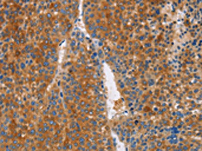 The image on the left is immunohistochemistry of paraffin-embedded Human liver cancer tissue using CSB-PA242213(LTF Antibody) at dilution 1/50, on the right is treated with fusion protein. (Original magnification: ×200)