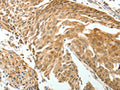 The image on the left is immunohistochemistry of paraffin-embedded Human cervical cancer tissue using CSB-PA242246(ROCK2 Antibody) at dilution 1/15, on the right is treated with fusion protein. (Original magnification: ×200)