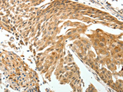 The image on the left is immunohistochemistry of paraffin-embedded Human cervical cancer tissue using CSB-PA242246(ROCK2 Antibody) at dilution 1/15, on the right is treated with fusion protein. (Original magnification: ×200)