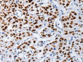 The image on the left is immunohistochemistry of paraffin-embedded Human lung cancer tissue using CSB-PA242639(MUTYH Antibody) at dilution 1/60, on the right is treated with fusion protein. (Original magnification: ×200)