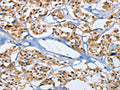 The image on the left is immunohistochemistry of paraffin-embedded Human thyroid cancer tissue using CSB-PA242652(DUSP19 Antibody) at dilution 1/30, on the right is treated with fusion protein. (Original magnification: ×200)