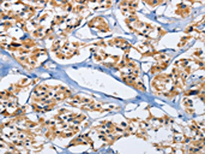 The image on the left is immunohistochemistry of paraffin-embedded Human thyroid cancer tissue using CSB-PA242652(DUSP19 Antibody) at dilution 1/30, on the right is treated with fusion protein. (Original magnification: ×200)