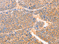 The image on the left is immunohistochemistry of paraffin-embedded Human liver cancer tissue using CSB-PA242653(PRDX2 Antibody) at dilution 1/80, on the right is treated with synthetic peptide. (Original magnification: ×200)