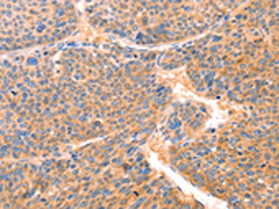 The image on the left is immunohistochemistry of paraffin-embedded Human liver cancer tissue using CSB-PA242653(PRDX2 Antibody) at dilution 1/80, on the right is treated with synthetic peptide. (Original magnification: ×200)